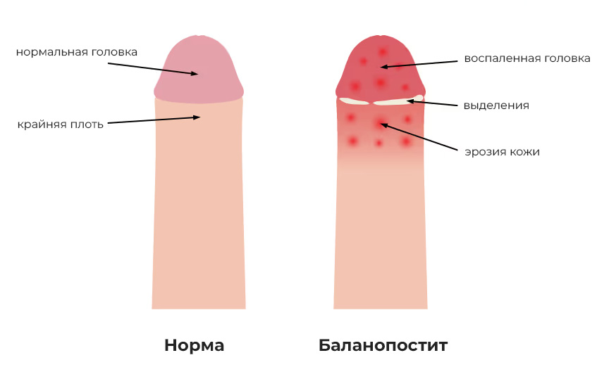 Баланопостит — симптомы, диагностика и лечение воспаления головки полового члена в АМ Медика